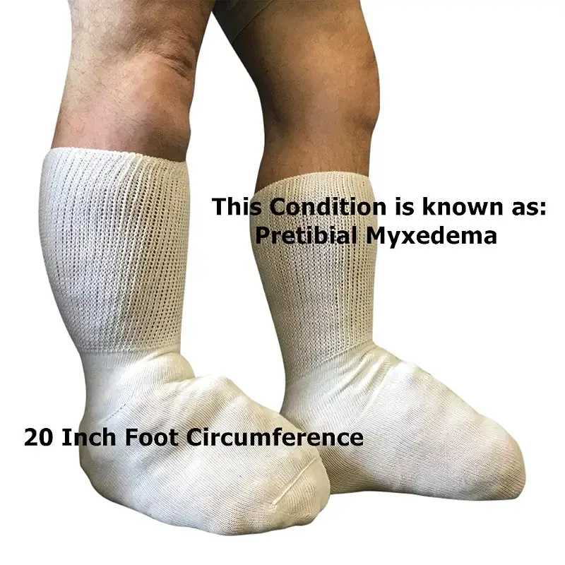 Bariatric Sock for Extreme Lymphedema Calf stretches to 30 inches Black — Body Support