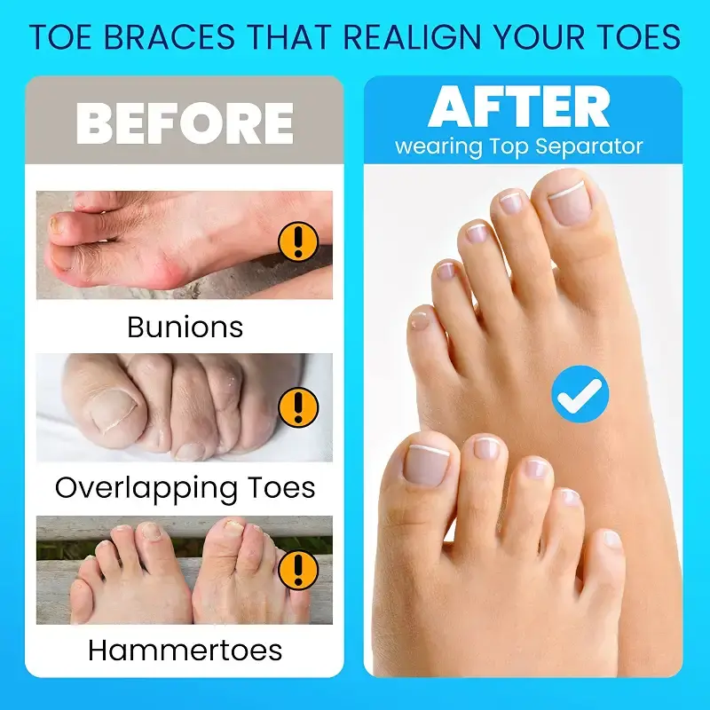 Toe Separator Toe Spacers for Feet 2 Pairs Premium Bunion Corrector for Women Men Hammer — pack of 2