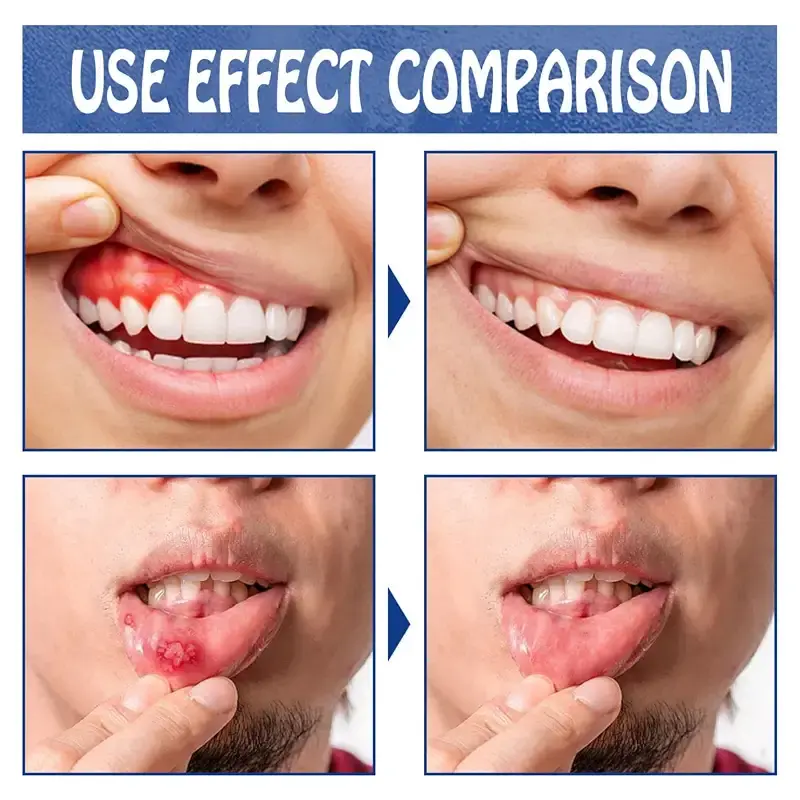Tooth Pain Relief Toothache Relieving Spray Dental Pain Relief Toothache Spray Instant — Spray